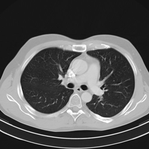 CT-thorax