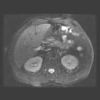 MRI abdomen 2